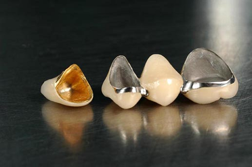 Răng sứ kim loại Titanium