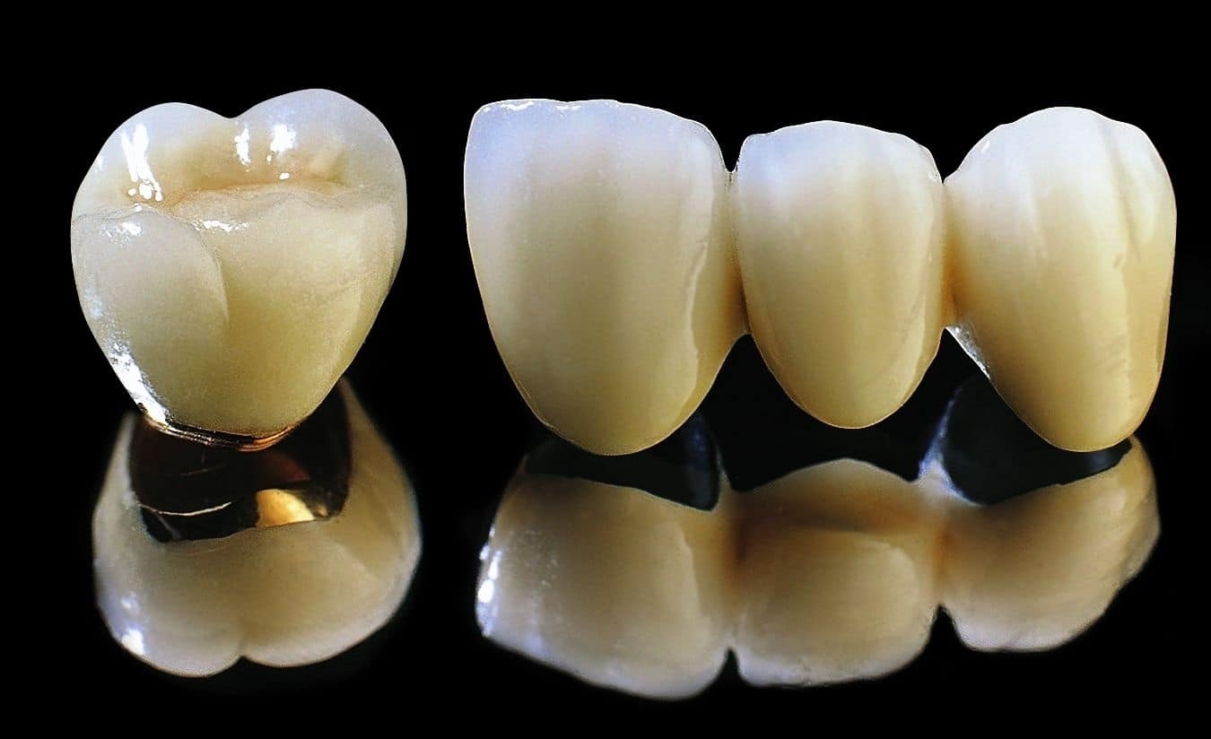 Răng sứ kim loại Crom-Cobalt