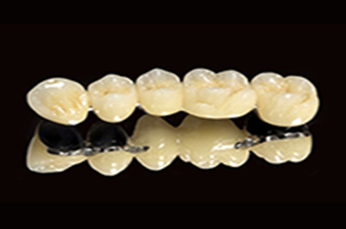 Răng sứ kim loại thường (Ni-Cr)